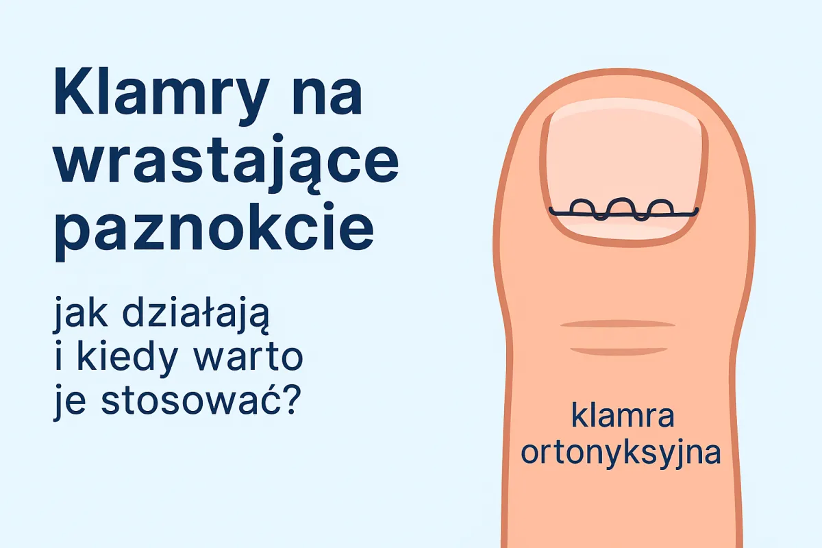 Klamry ortonyksyjne na wrastające paznokcie – bezinwazyjna terapia w Klinice Zdrowych Stóp Płock