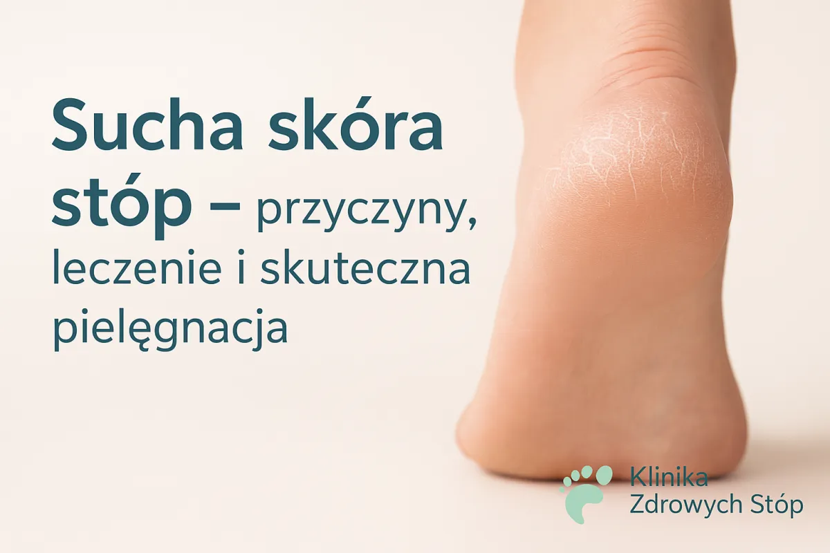 Sucha skóra stóp – przyczyny, leczenie i pielęgnacja | Podolog Płock