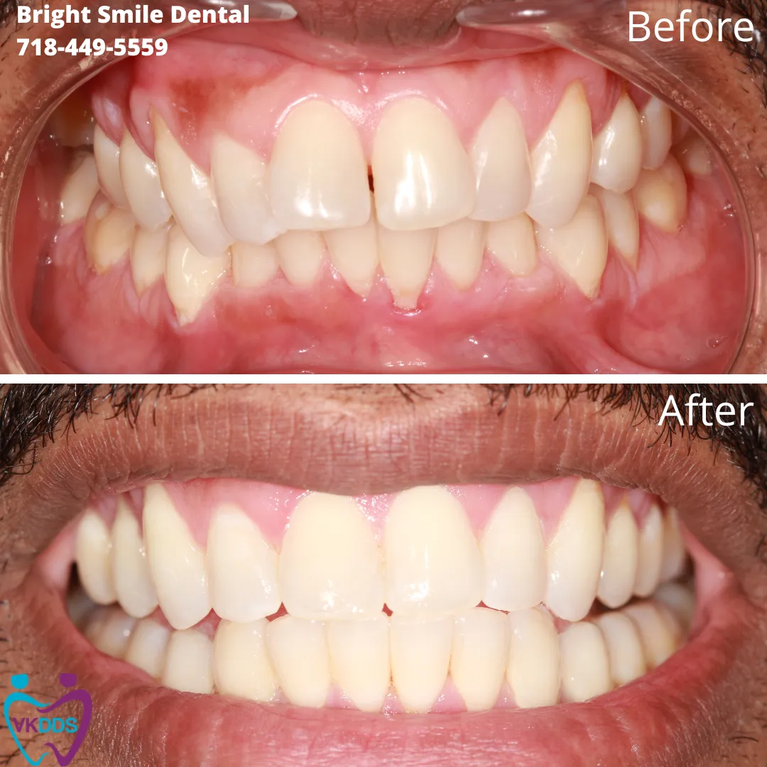 Invisalign Treatment
