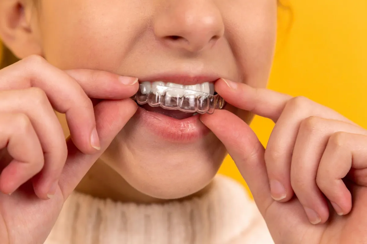 Invisalign Braces- Tips and Tricks
