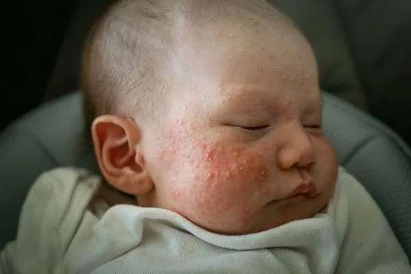 baby with allergy