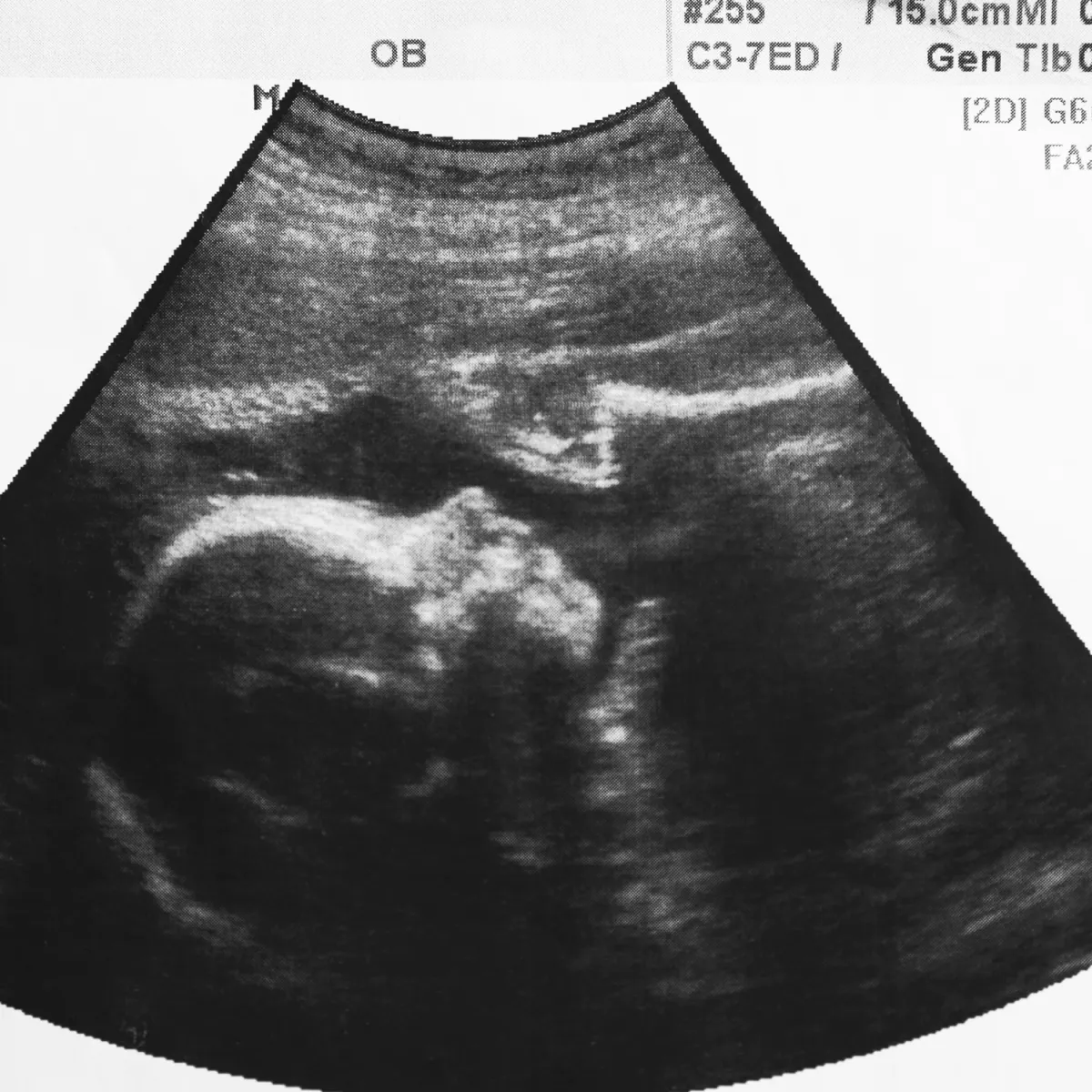 An ultrasound image shows a side profile of a developing fetus inside the womb. The head, body, and limbs are clearly visible in the black-and-white scan, indicating the baby’s position and growth stage.
