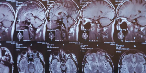 Childhood Concussions: Symptoms, Risks & Expert Care in Geneva, IL