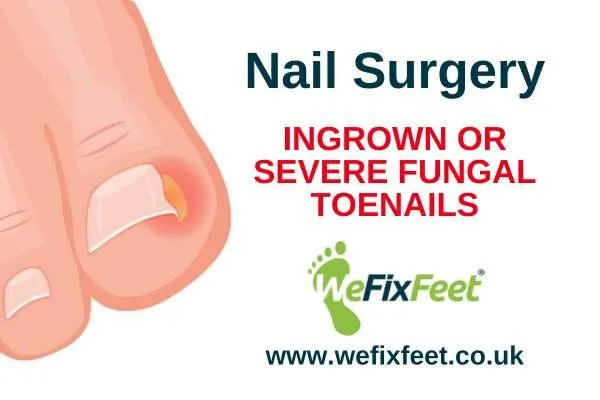 Toenail Surgery - We Fix Feet Beeston, Nottingham & Ilkeston, Derby