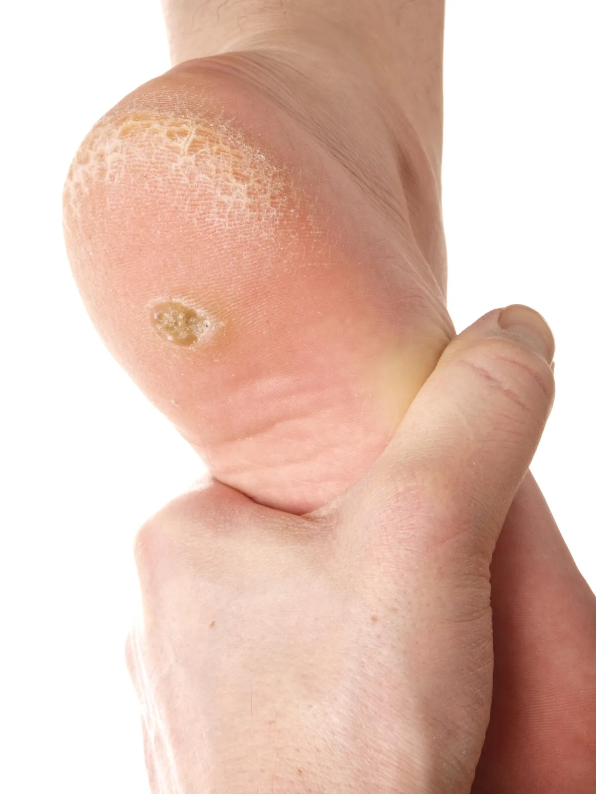 Verruca. We Fix Feet, Ilkeston and Beeston.