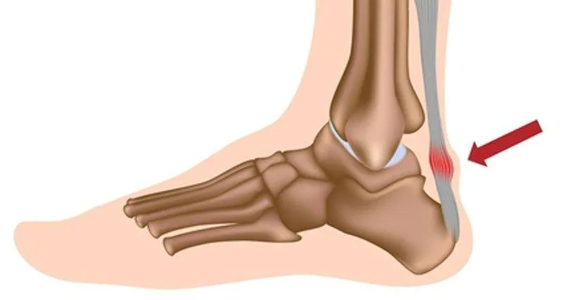 Pain in the Achilles. We Fix Feet, Beeston and Ilkeston.