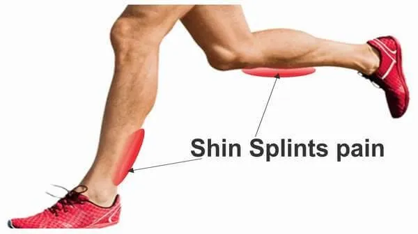 We Fix Feet Shin Splints