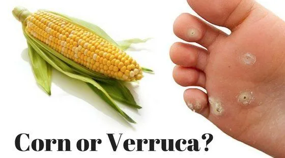 Verruca or Corn? Spot the difference