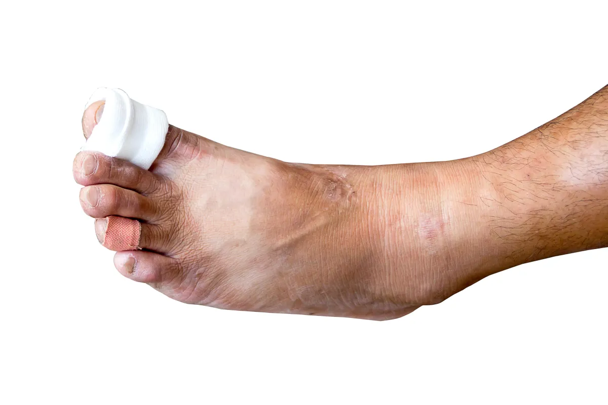 WFF - Ingrown Toenail