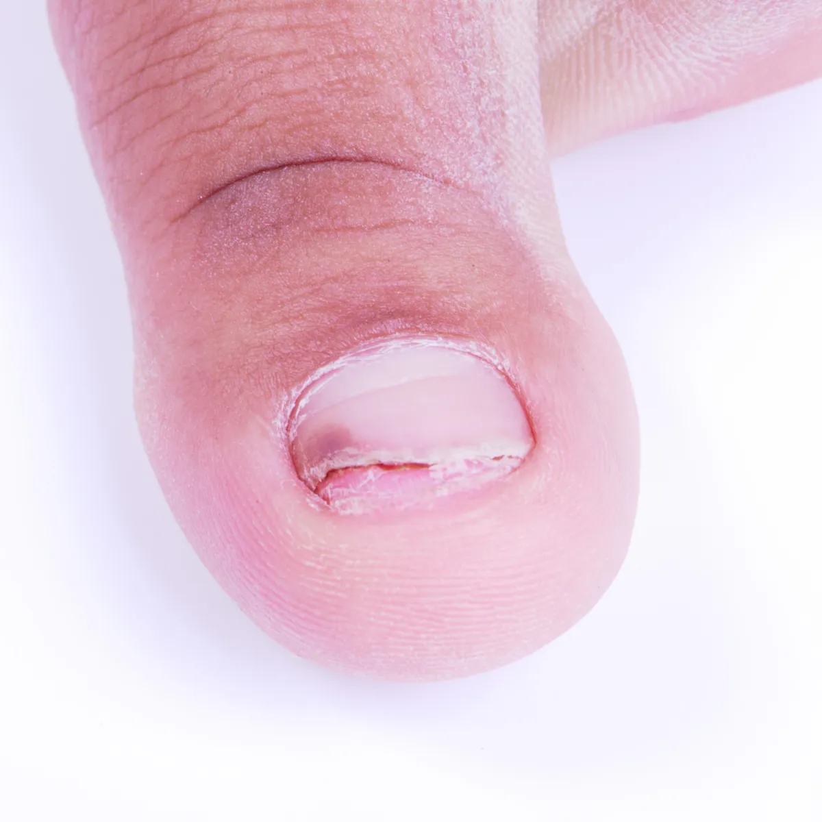 WFF - Ingrown Toenails