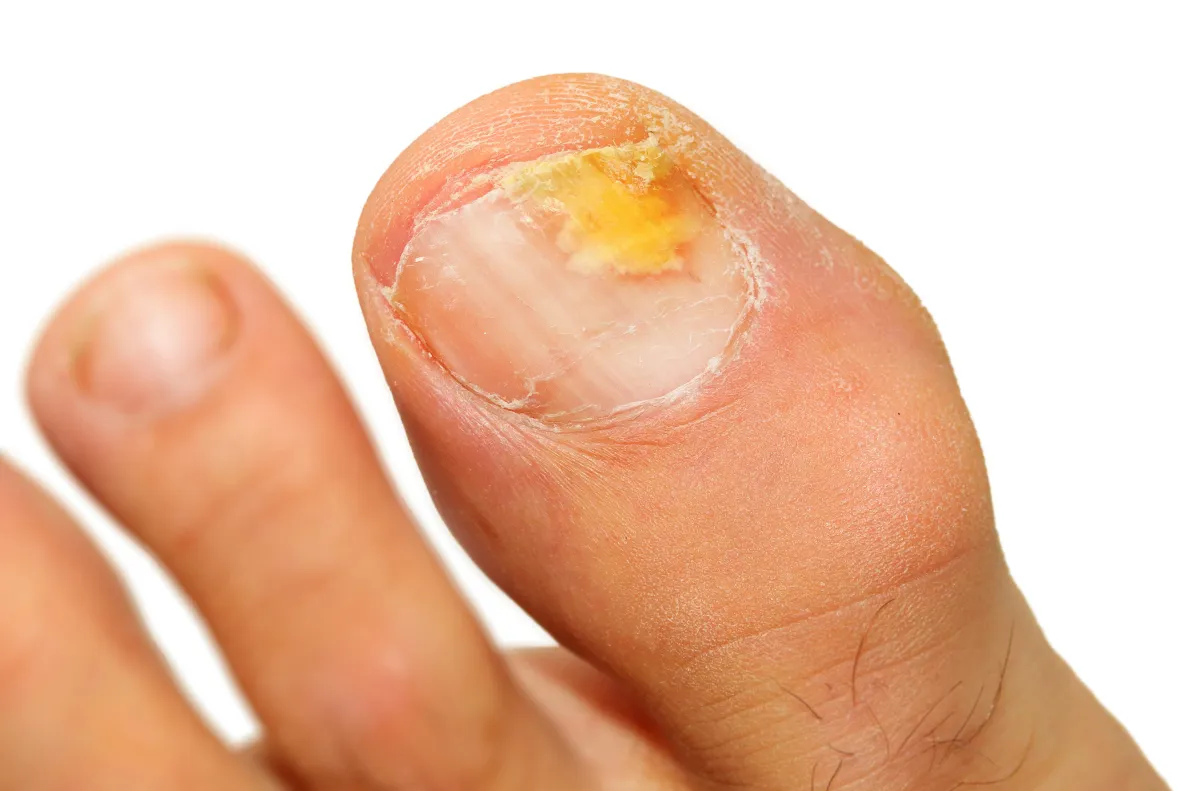 Fungal Nail. We Fix Feet.