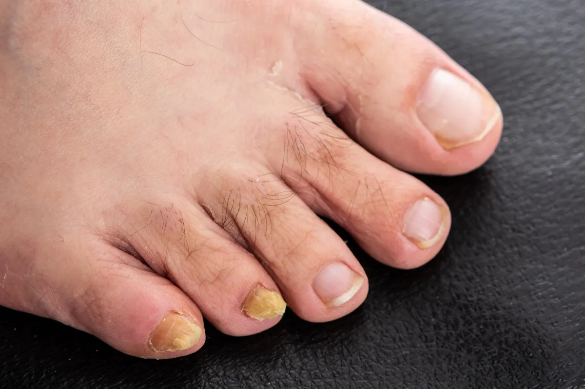 Fungal Nails. We Fix Feet, Beeston and Ilkeston.