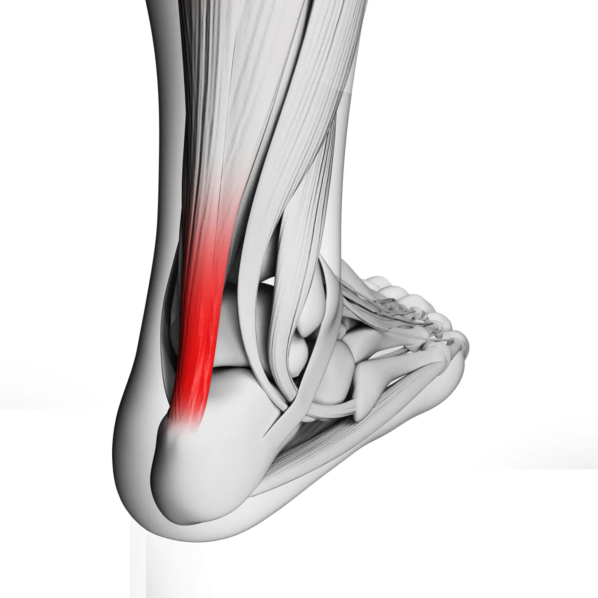 Achilles Pain. We Fix Feet, Beeston and Ilkeston