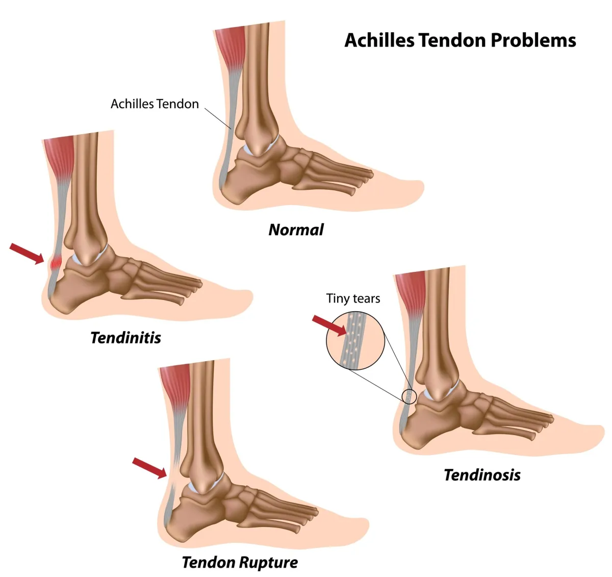 Achilles Pain. We Fix Feet, Beeston and Ilkeston. 