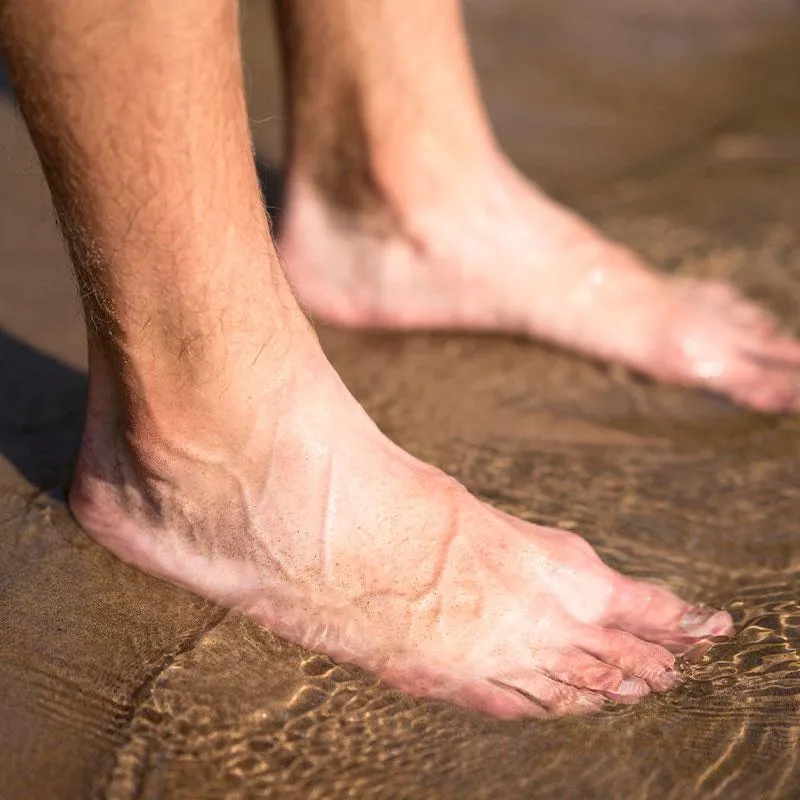Corn on feet. We Fix Feet, Clinics in Beeston and Ilkeston.