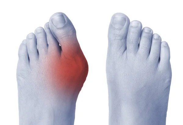 WFF - Bunion Pain