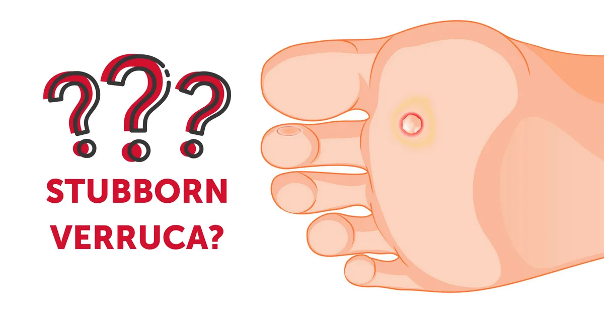 Verruca. We Fix Feet, Clinics in Beeston and Ilkeston.