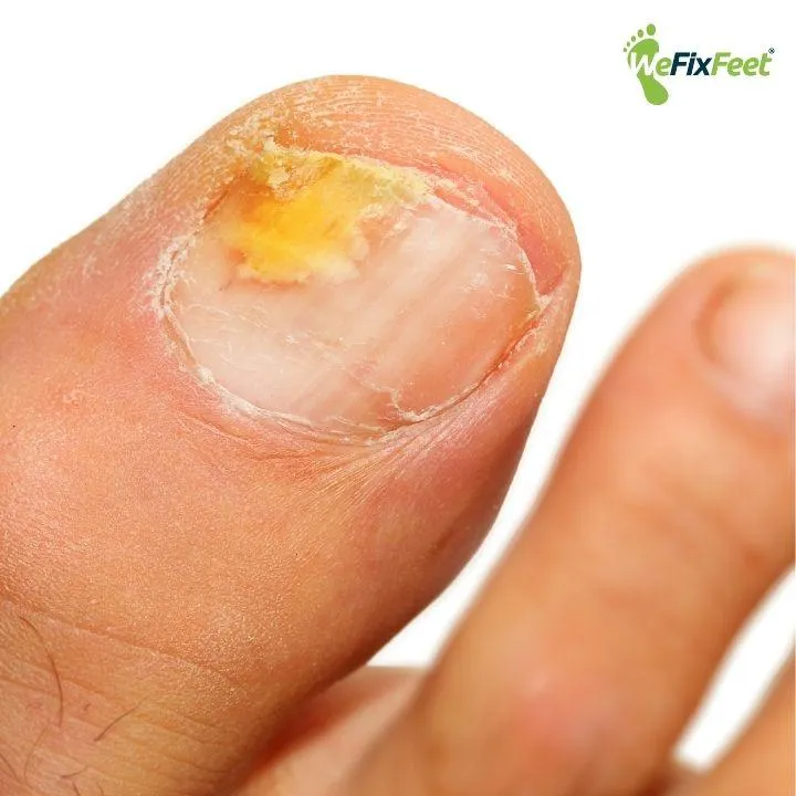 Fungal nail. We Fix Feet, Beeston and Ilkeston.