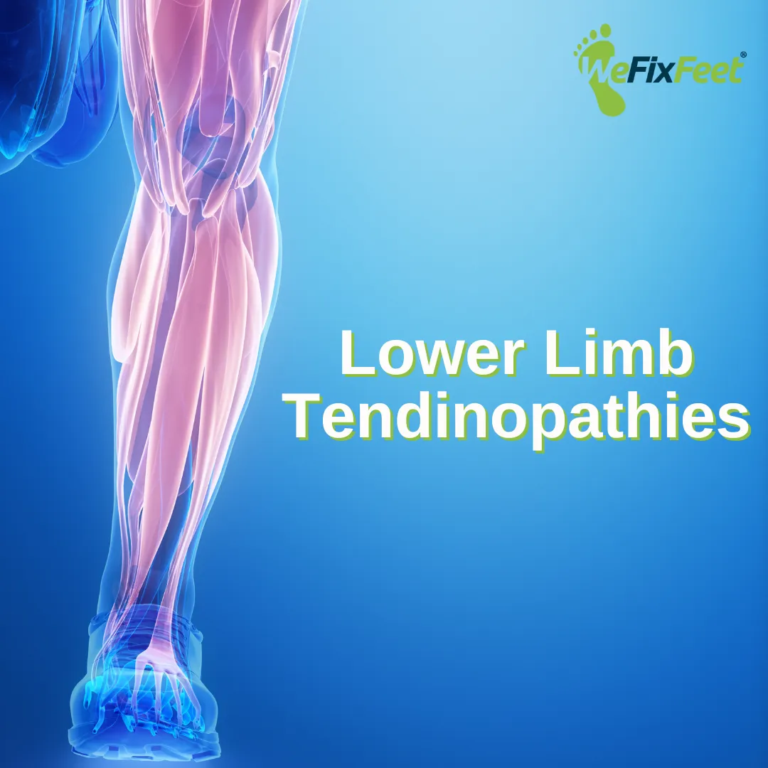 Lower limb tendinopathies. We Fix Feet, Beeston and Ilkeston.