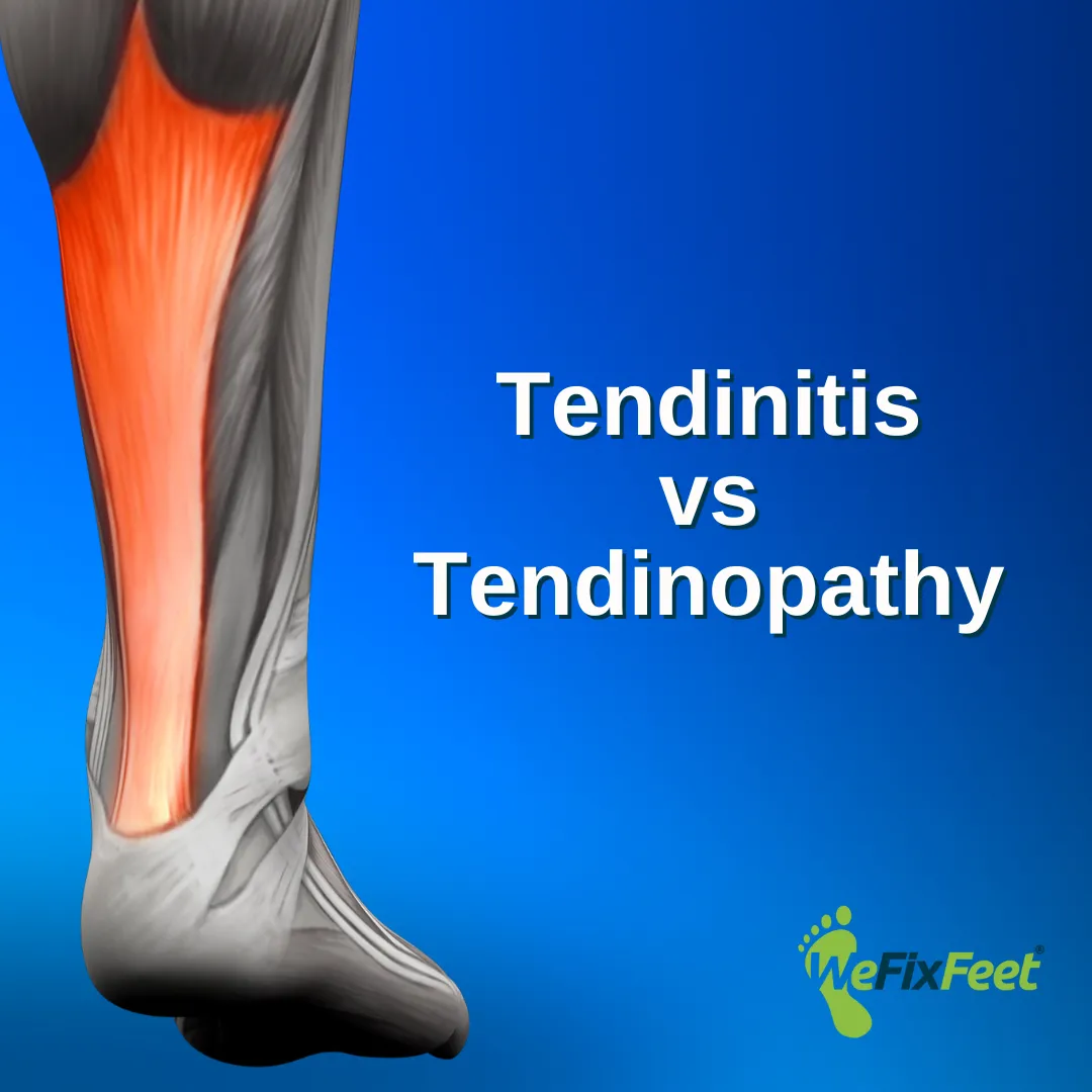 Tendinitis vs Tendinopathy. We Fix Feet, Beeston and Ilkeston