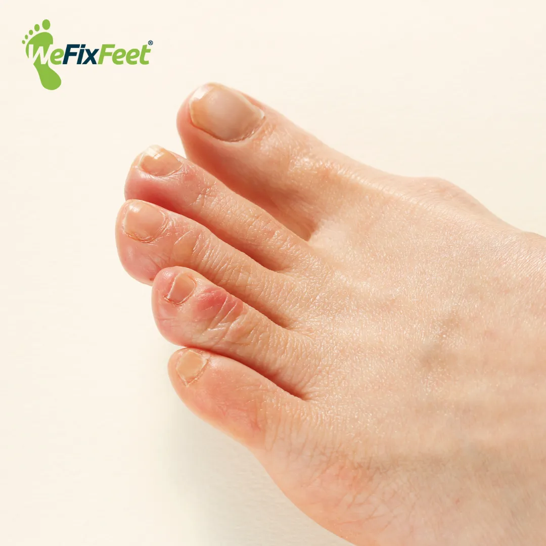 Chilblains. We Fix Feet, clinics in Beeston and Ilkeston