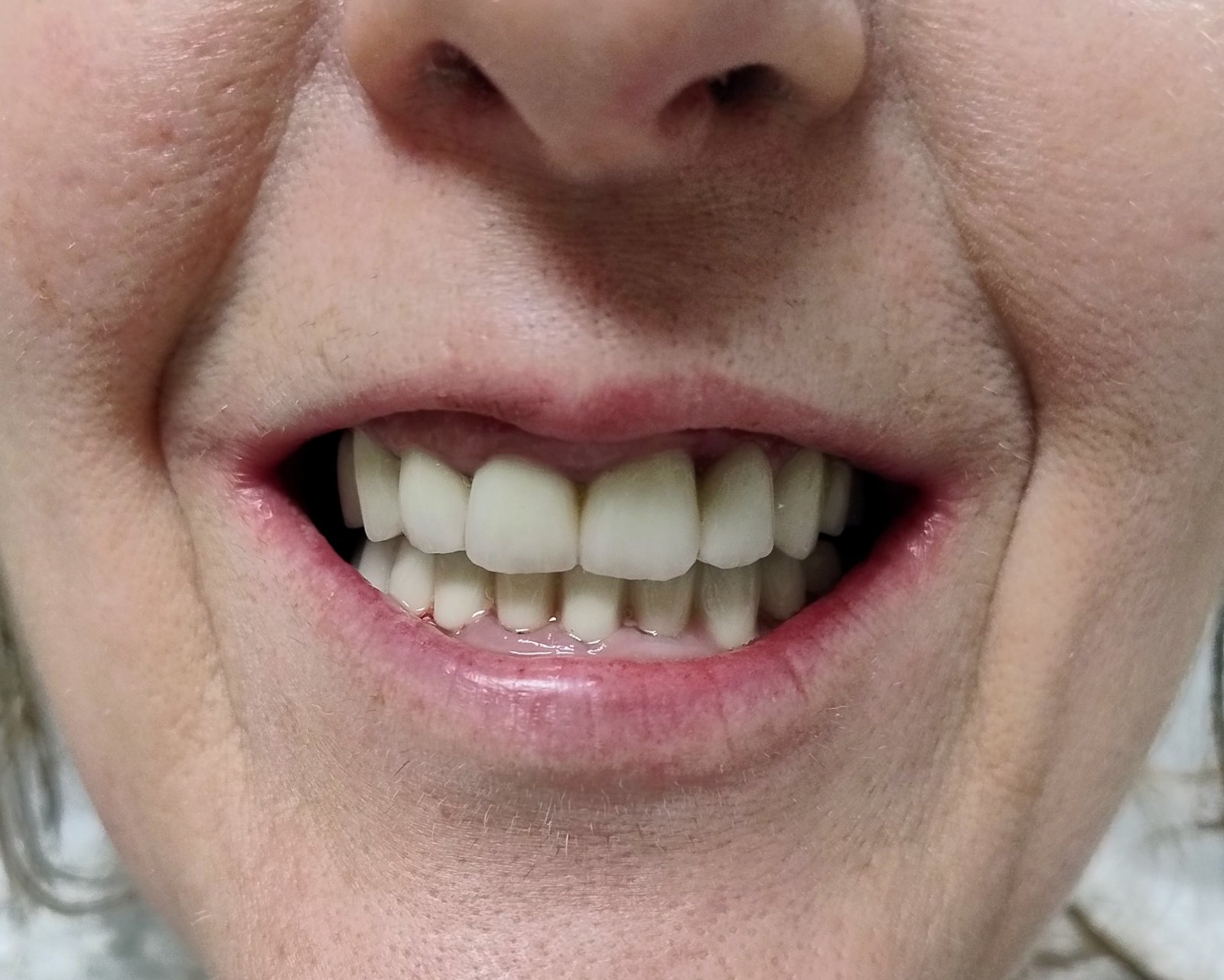 Металокерамички коронки