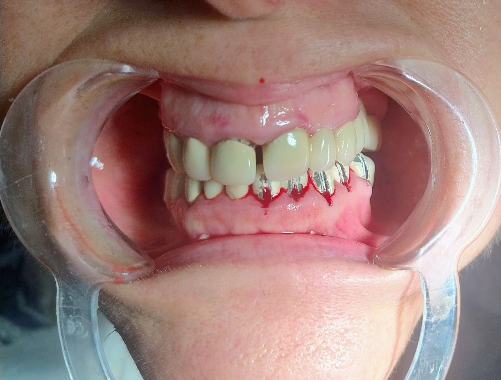 Оштетени заби