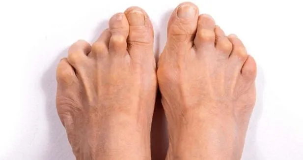 Biomechanix Clinic Coventry Foot Doctor, signs of athritis in foot