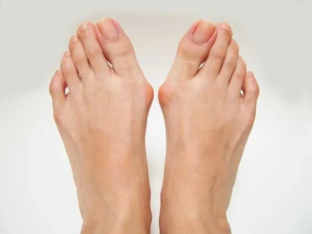 Bunion 