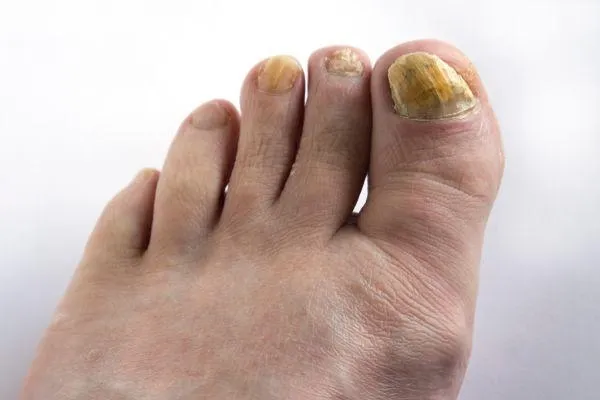 thickened toenails podiatry