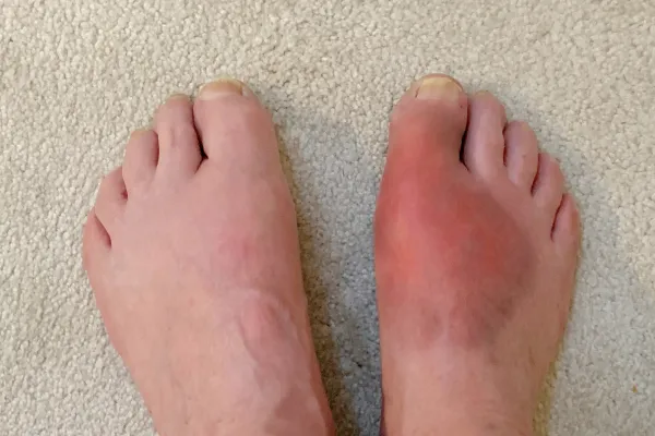 gout foot
