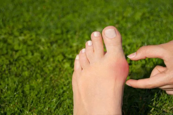 bunion pain