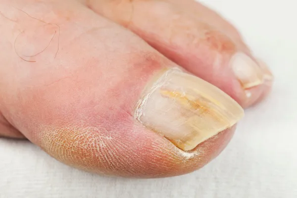 Thick, Discoloured Toenails? It Might Be a Fungal Infection