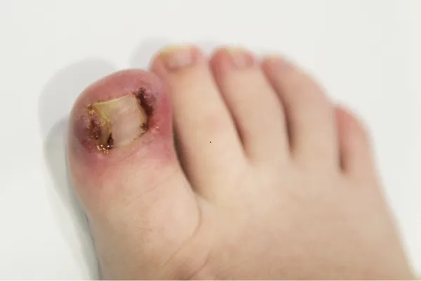 Why You Should Not Ignore Your Ingrown Toenail