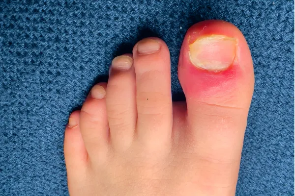 🚨 Ingrown Toenail Trouble? Here’s Why It’s Time to Call the Pros (That’s Us 👣)