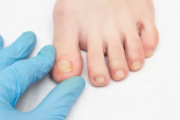 KeryFlex Nail Restoration: Confidence Without the Fungus