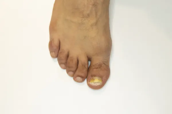 Why Your Toenail Is Turning Yellow (And What to Do About It)