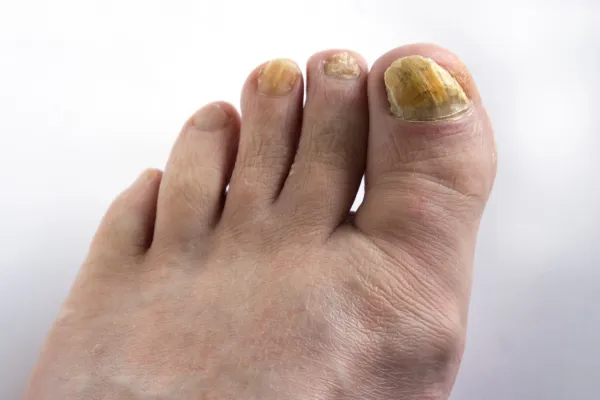 Ugly Toenails? Here’s How We Restore Them at Our Florida Clinics