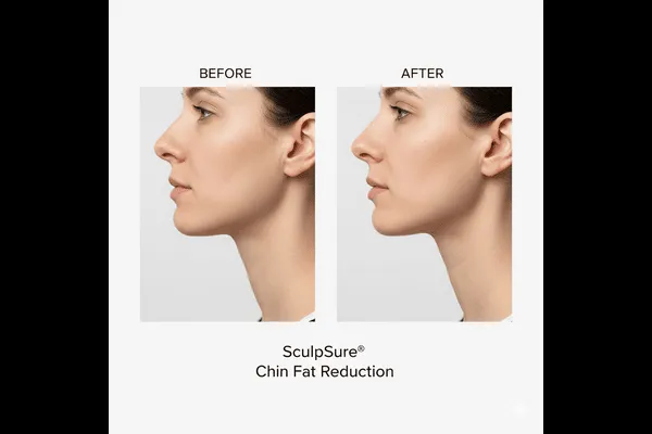 Before and after comparison showing chin fat reduction and improved jawline contour after SculpSure treatment.