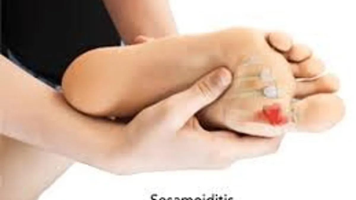 Sesamoiditis insoles top