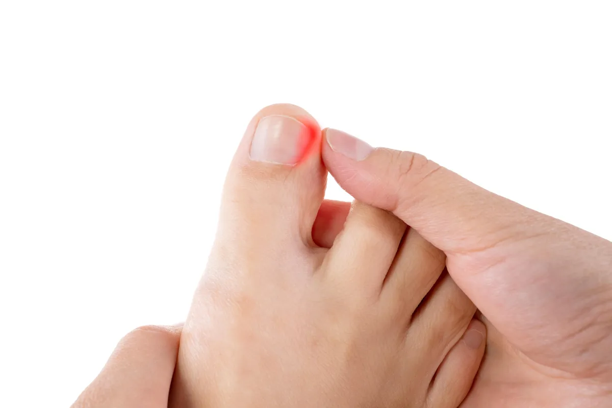 How to Fix an Ingrown Toenail