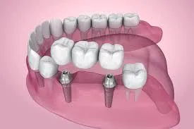 How Dental Bridges Restore Your Smile and Improve Chewing Ability