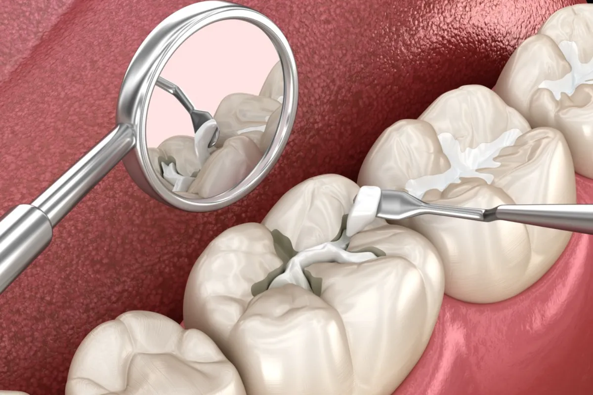 “dentist inspecting old filling for cracks”