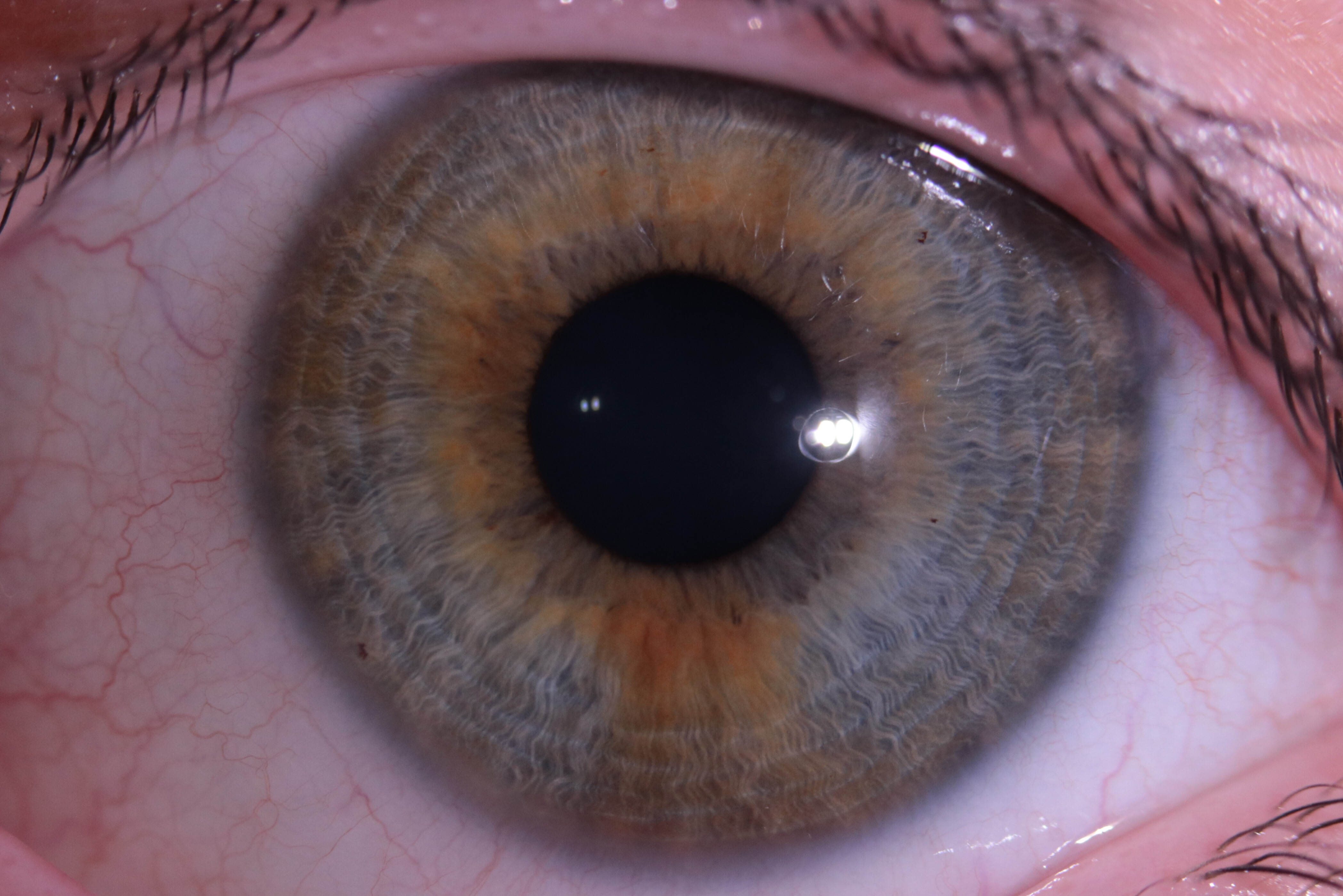lymphatic iris