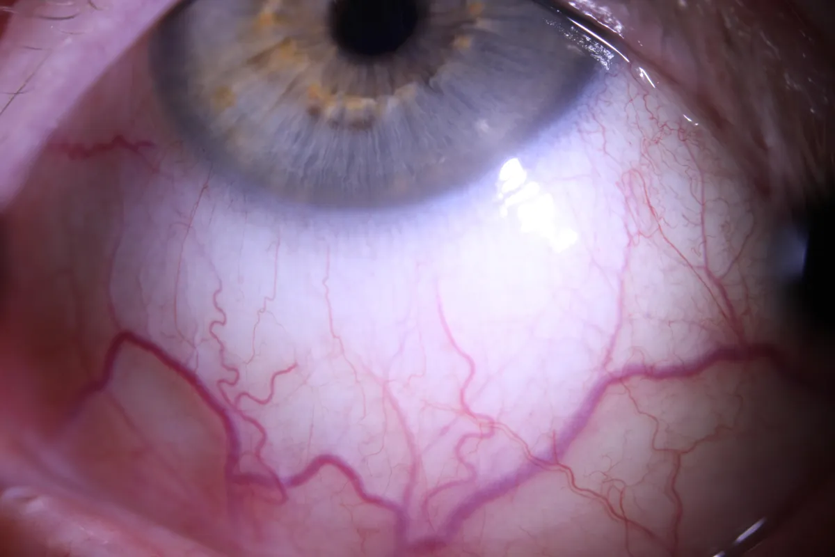 lower quadrant, left eye