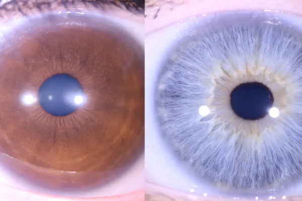 pupil shape