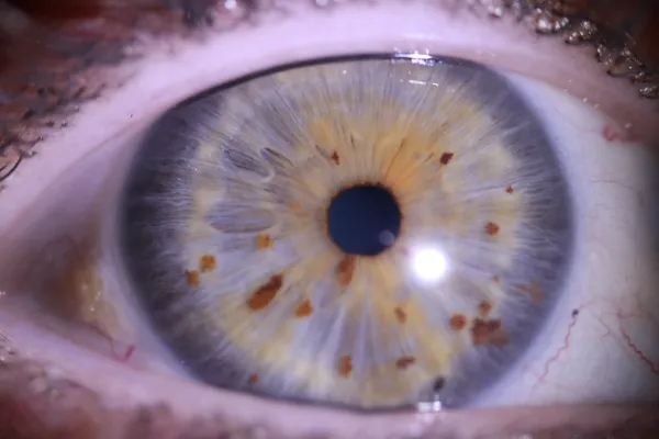 Blue eye with color flecks