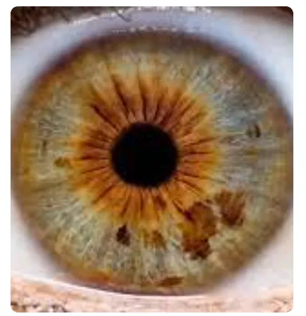 Iridology