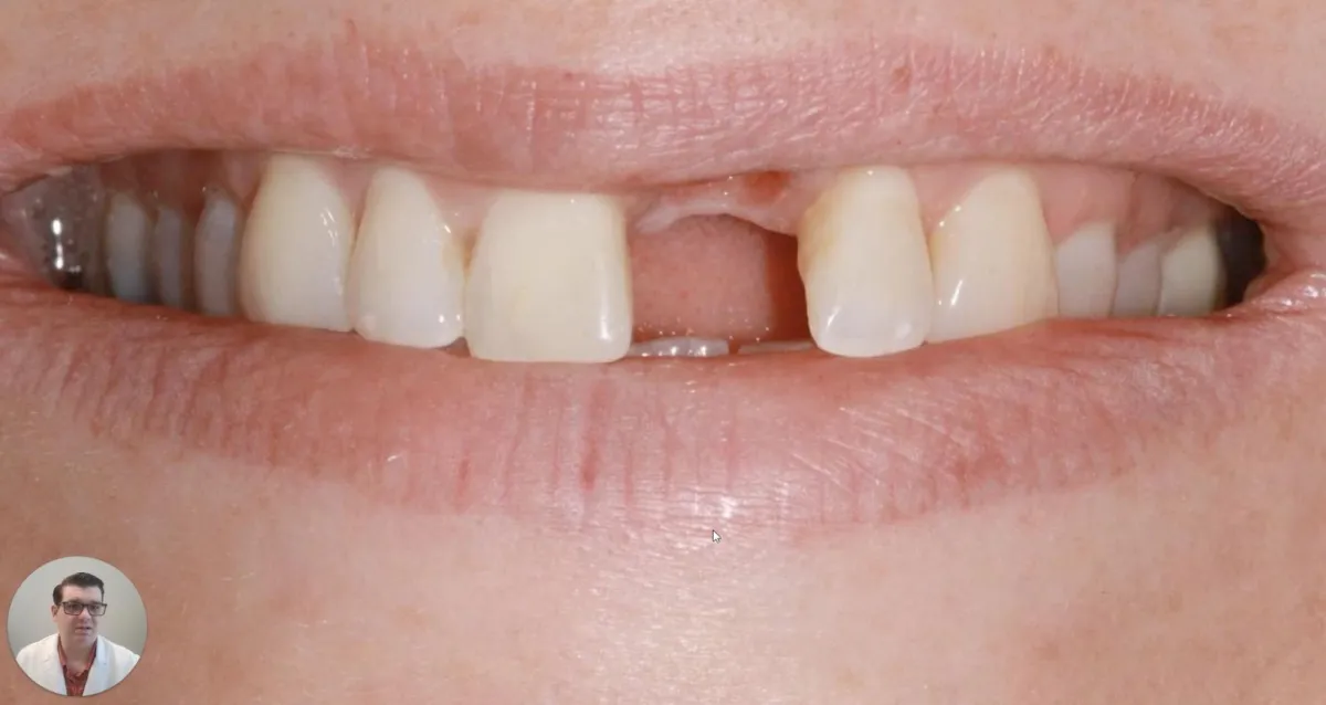 Missing Tooth Restoration