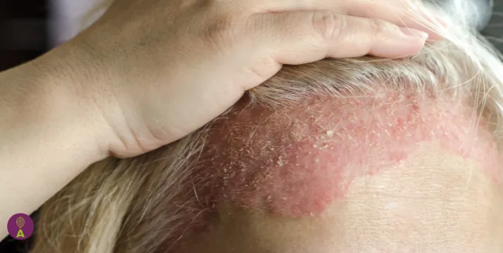 dermatitis seborreica